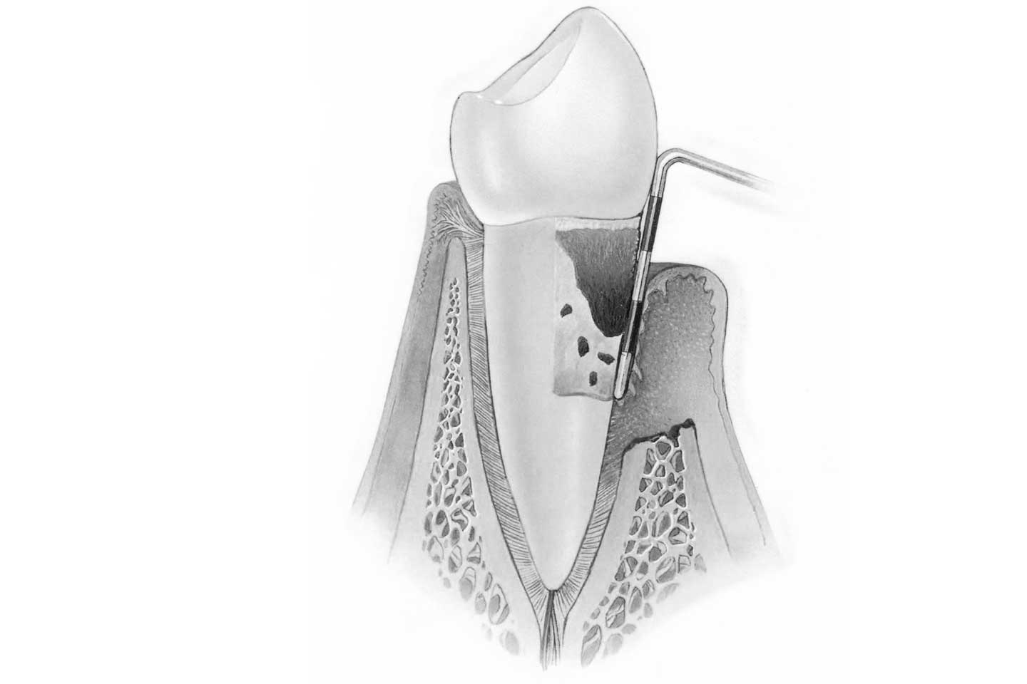 Ortodoncia con periodontitis