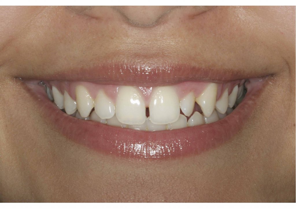 Nuevas carillas sin desgastar el diente Luminners - Clinica Dental Sciaini