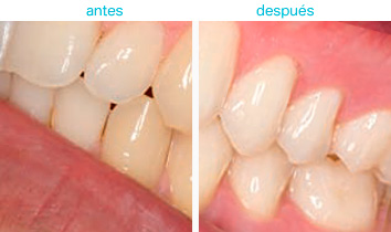 blanqueamiento dental 1
